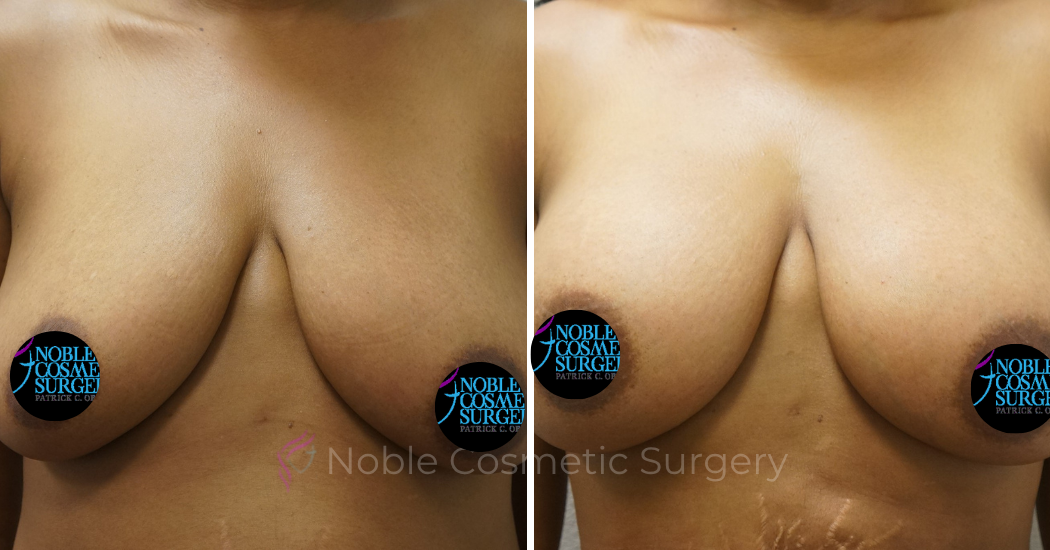 BREAST-AUGMENTATION--WITH-FAT-TRANSFER--CASE-00268 | Before and After Breast Augmentation