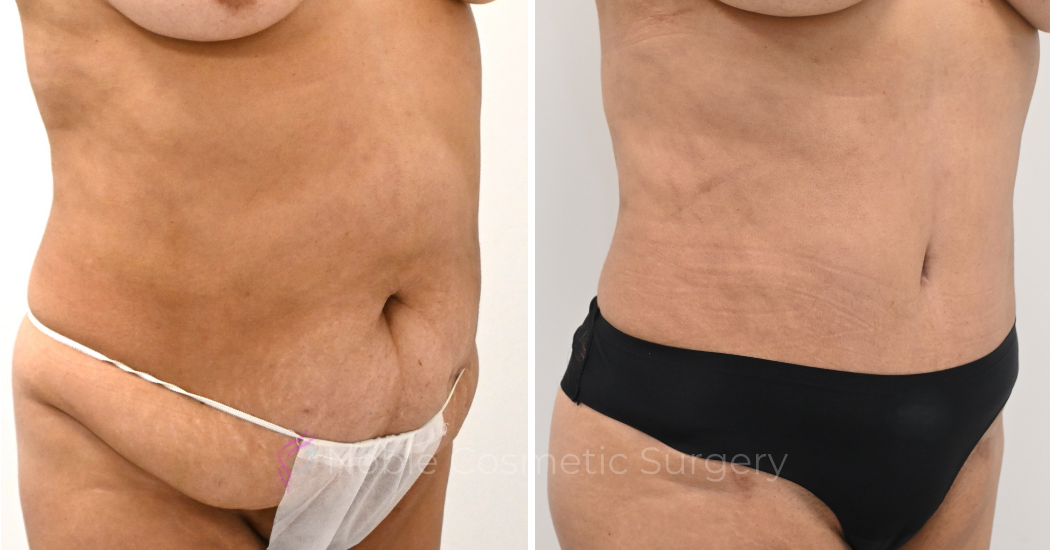 TUMMY-TUCK-CASE-00324 | Before and After Abdominoplasty 2