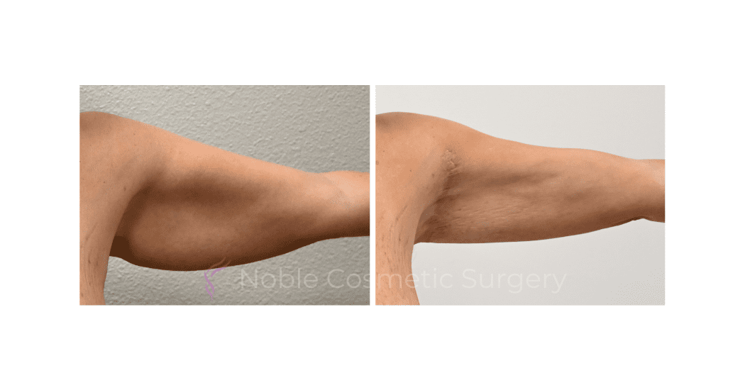 ARM-LIFT-CASE-00257 | Before and After Brachioplasty