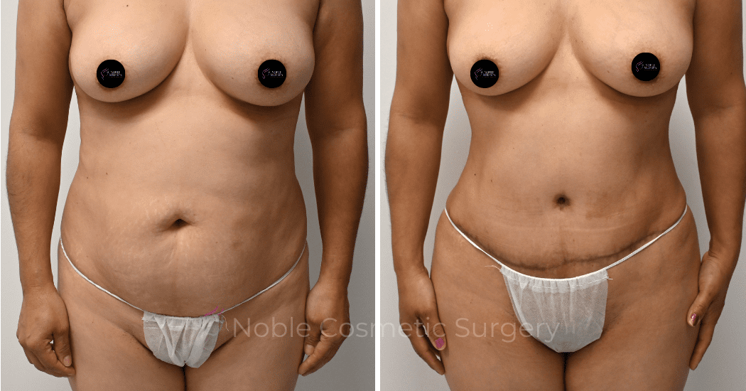 TUMMY-TUCK-CASE-00313 | Before and After Abdominoplasty 1