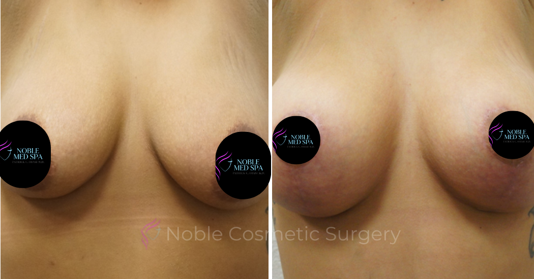 BREAST-AUGMENTATION--WITH-LIFT--CASE-00309 | Before and After Breast Augmentation with Lift