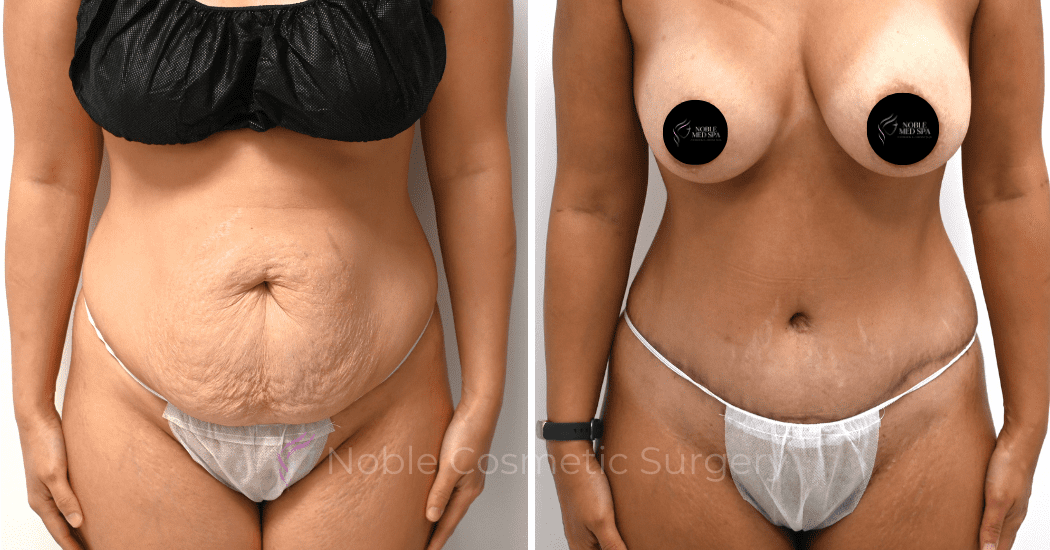 TUMMY-TUCK-CASE-00316 | Before and After Abdominoplasty 1