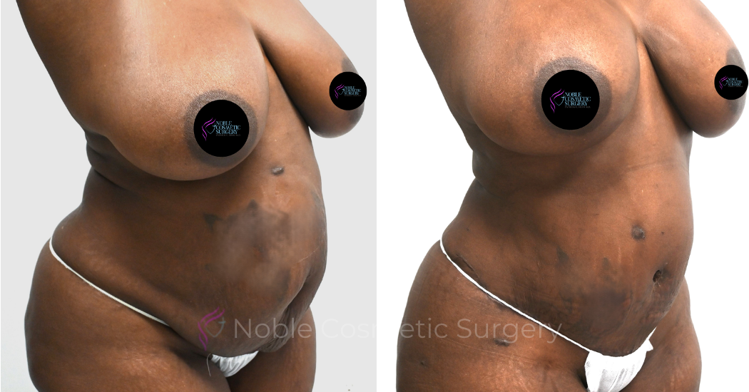 TUMMY-TUCK-CASE-00323 | Before and After Abdominoplasty 2