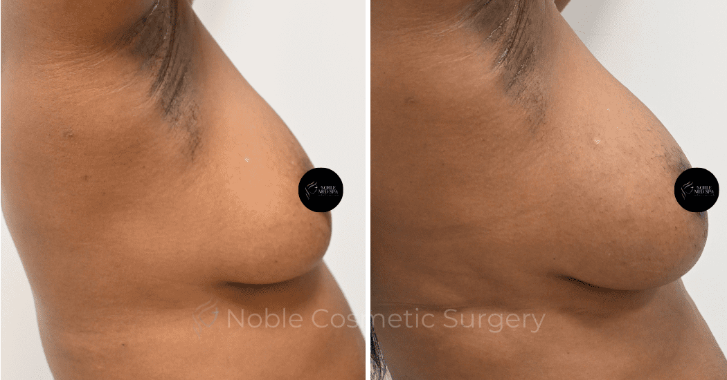 BREAST-AUGMENTATION-WITH-FAT-TRANSFER-CASE-00261 | Before and After Breast Augmentation