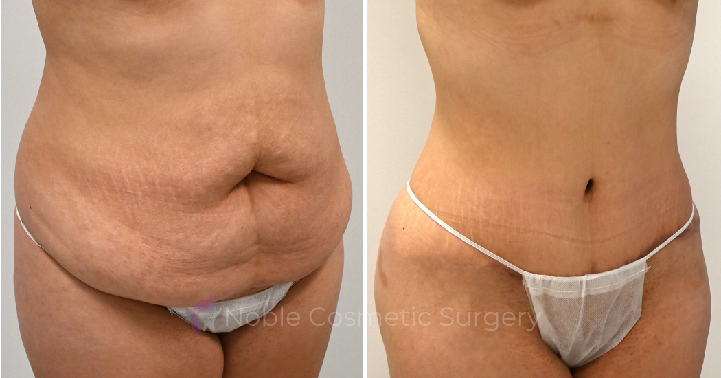 TUMMY-TUCK-CASE-00325 | Before and After Abdominoplasty 1