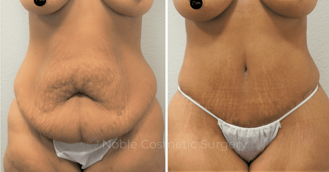 TUMMY-TUCK-CASE-00301 | Before and After Abdominoplasty 1