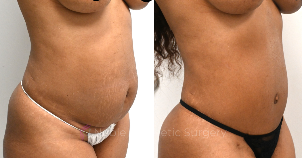 TUMMY-TUCK-CASE-00326 | Before and After Abdominoplasty 2