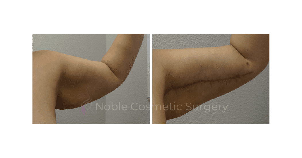 ARM-LIFT-CASE-17203 | Before and After Brachioplasty