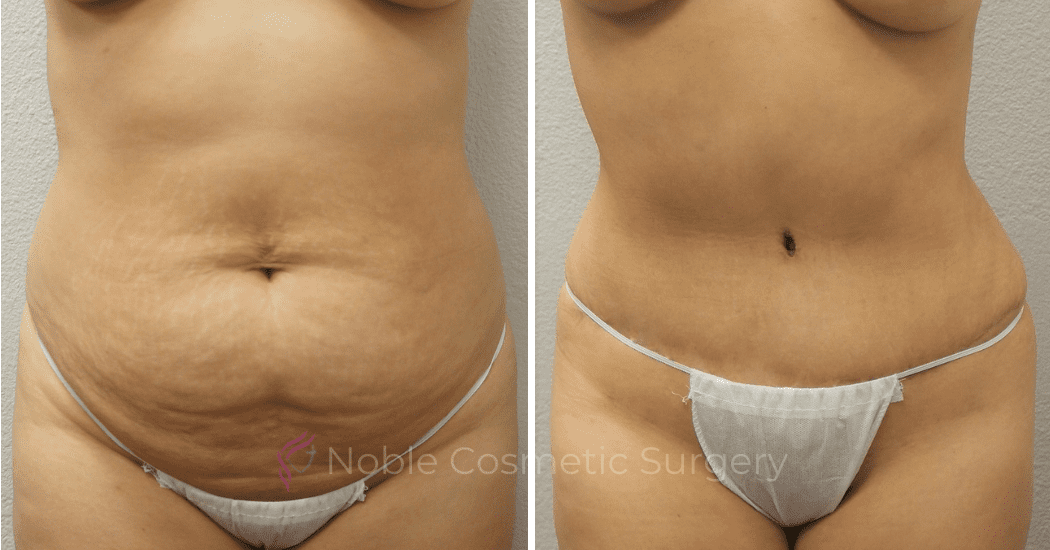 TUMMY-TUCK-CASE-00304 | Before and After Abdominoplasty 1