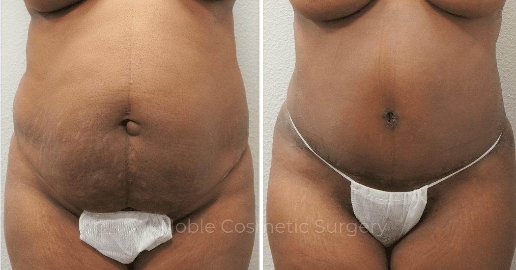 TUMMY-TUCK-CASE-00306 | Before and After Abdominoplasty 1