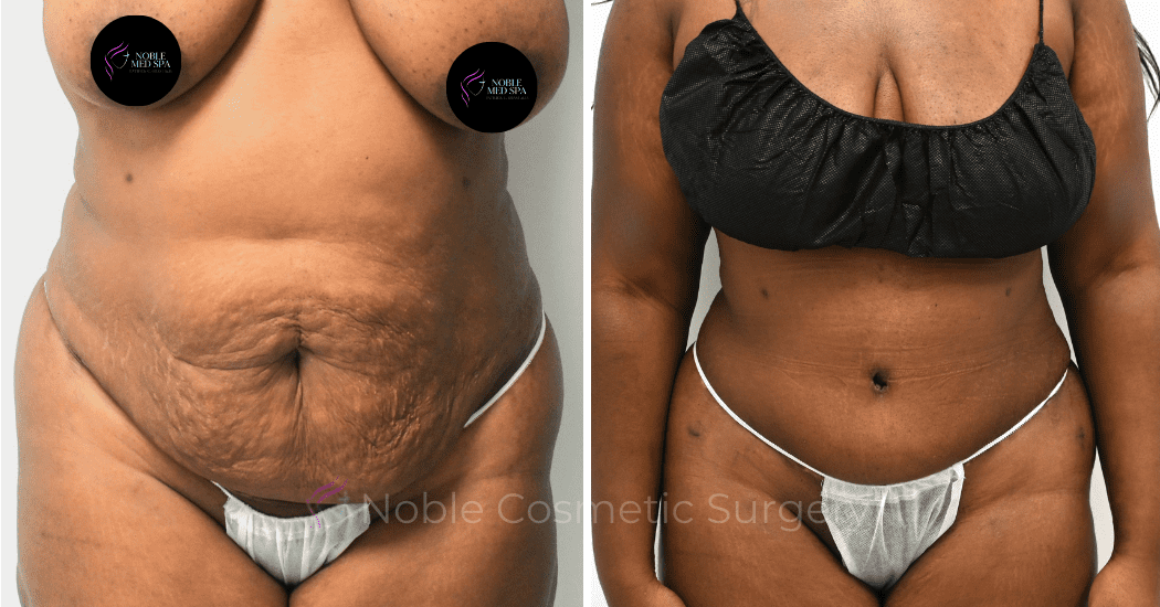 TUMMY-TUCK-CASE-00308 | Before and After Abdominoplasty 1