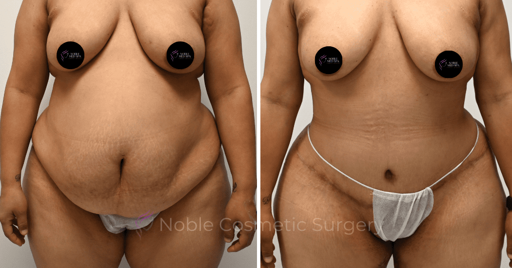 TUMMY-TUCK-CASE-00310 | Before and After Abdominoplasty 1