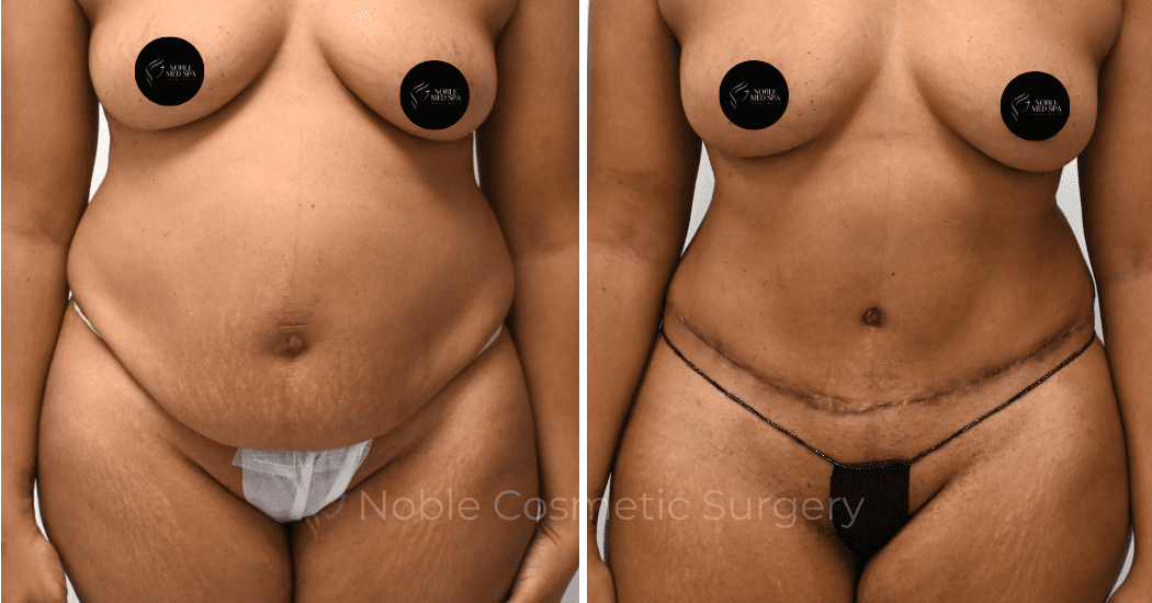 TUMMY-TUCK-CASE-00312 | Before and After Abdominoplasty 1