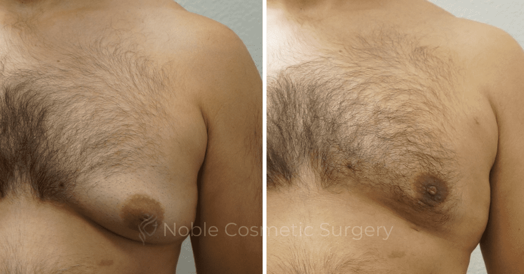 GYNECOMASTIA--CASE-16730 | Before and After Gynecomastia