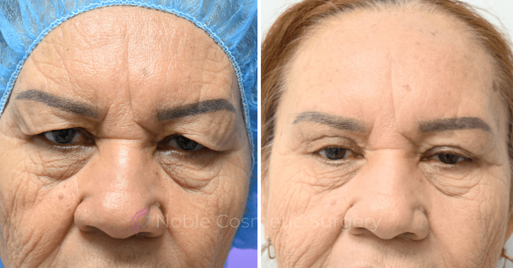 BLEPHAROPLASTY-CASE-10180 | Before and After Blepharoplasty