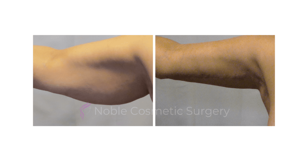 ARM-LIFT-CASE-19050 | Before and After Brachioplasty