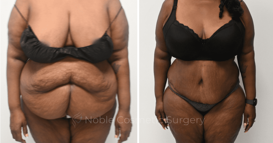 TUMMY-TUCK-CASE-00321 | Before and After Abdominoplasty 1