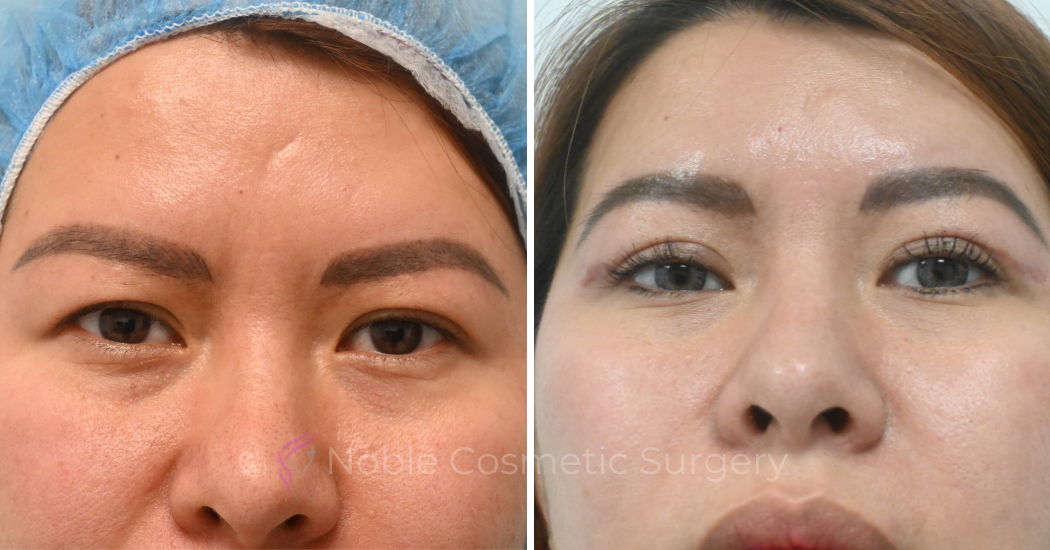 BLEPHAROPLASTY-CASE-10083 | Before and After Blepharoplasty