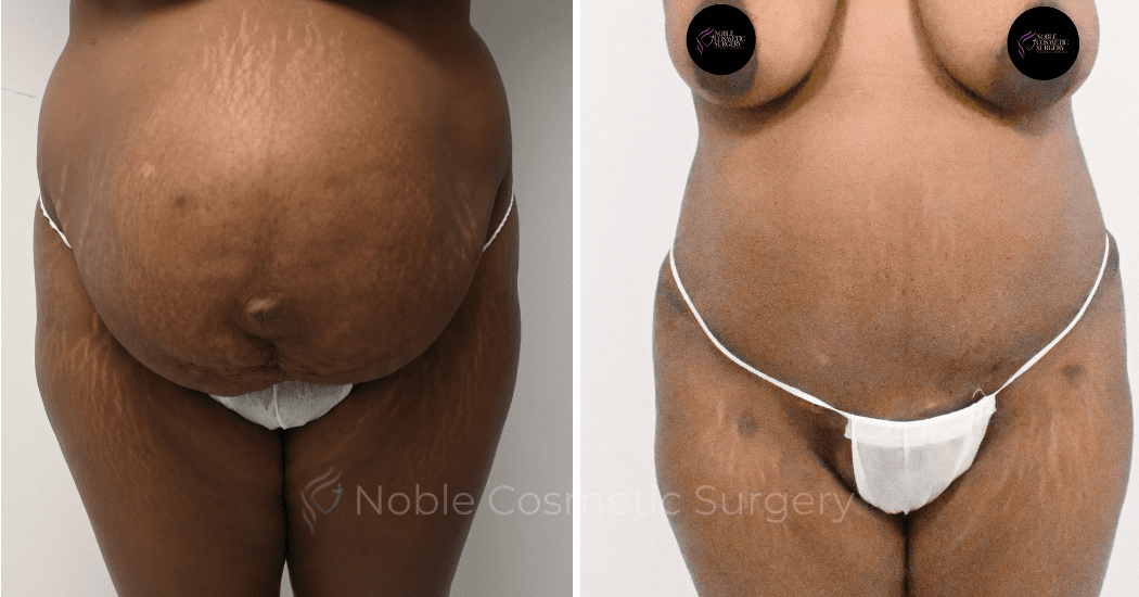 TUMMY-TUCK-CASE-11379 | Before and After Abdominoplasty
