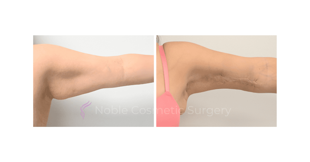 ARM-LIFT-CASE-15380 | Before and After Brachioplasty