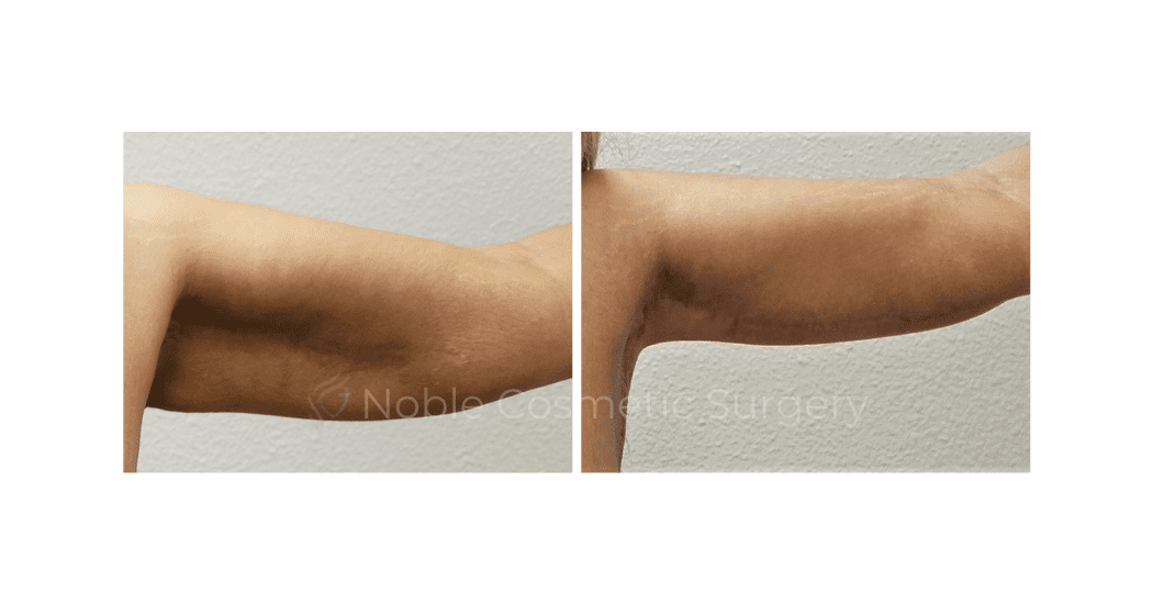 ARM-LIFT-CASE-00253 | Before and After Brachioplasty