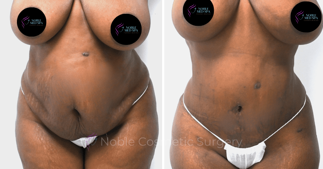 TUMMY-TUCK-CASE-00300 | Before and After Abdominoplasty 1