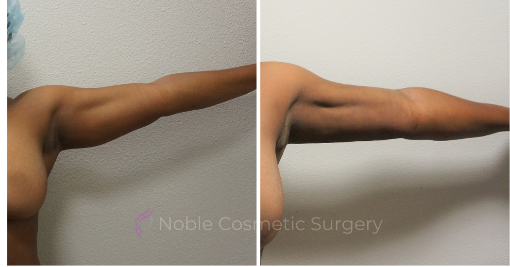 LIPOSUCTION-ARMS-CASE-00500 | Before and After Arm Liposuction