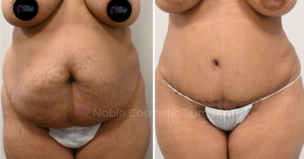 TUMMY-TUCK-CASE-00031 | Before and After Abdominoplasty 1