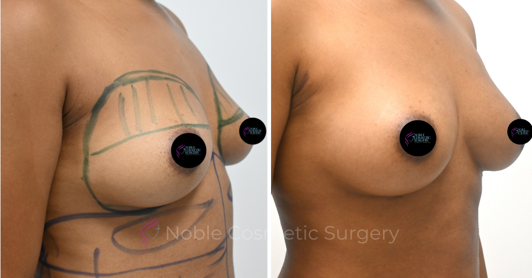 BREAST-AUGMENTATION--WITH-FAT-TRANSFER--CASE-11111 | Before and After Breast Augmentation