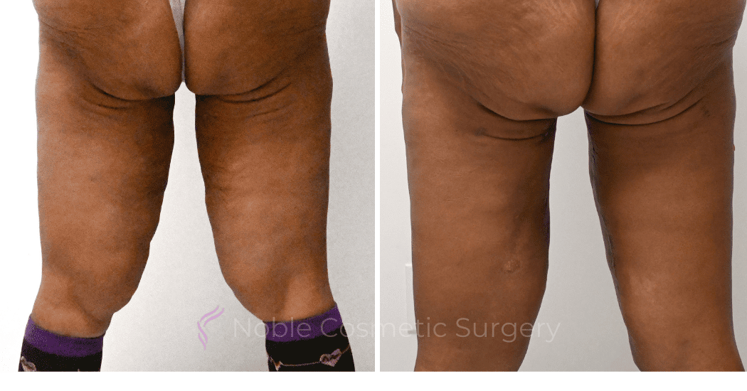 Thigh-Lift-Case-10384 | Before and After Thigh Lift 2