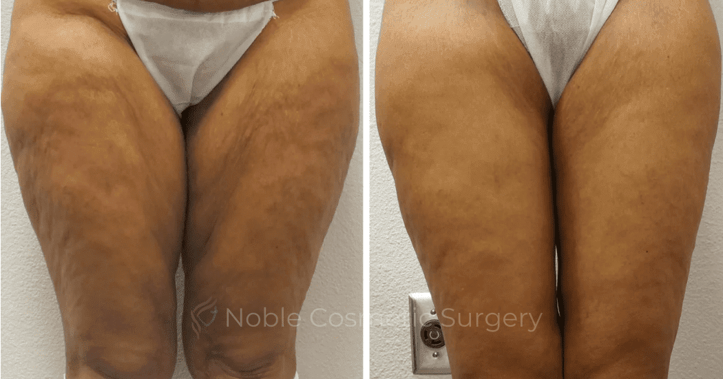 Thigh-Lift-Case-10385 | Before and After Thigh Lift