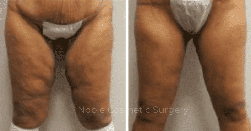 Thigh-Lift-Case-10387 | Before and After Thigh Lift