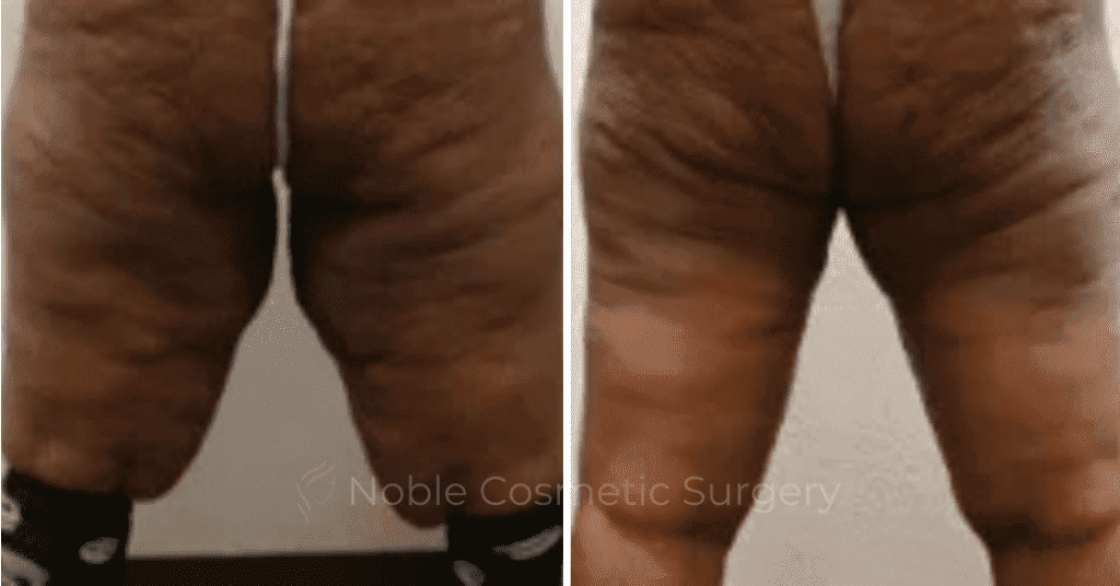 Thigh-Lift-Case-10389 | Before and After Thigh Lift 2