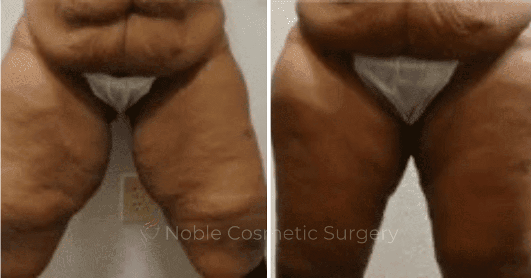 Thigh-Lift-Case-10389 | Before and After Thigh Lift