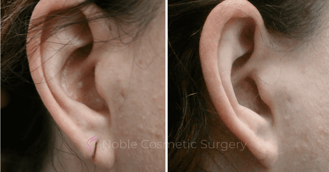 Earlobe-Repair-Case-20256 | Before and After Earlobe Repair