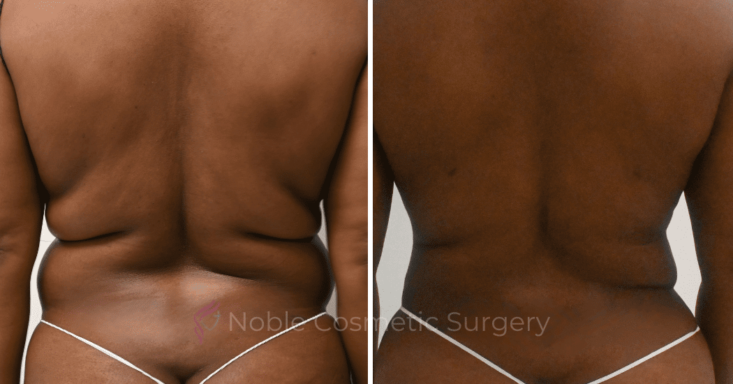 LIPOSUCTION-ABDOMEN-CASE-10873 | Before and After Liposuction 5