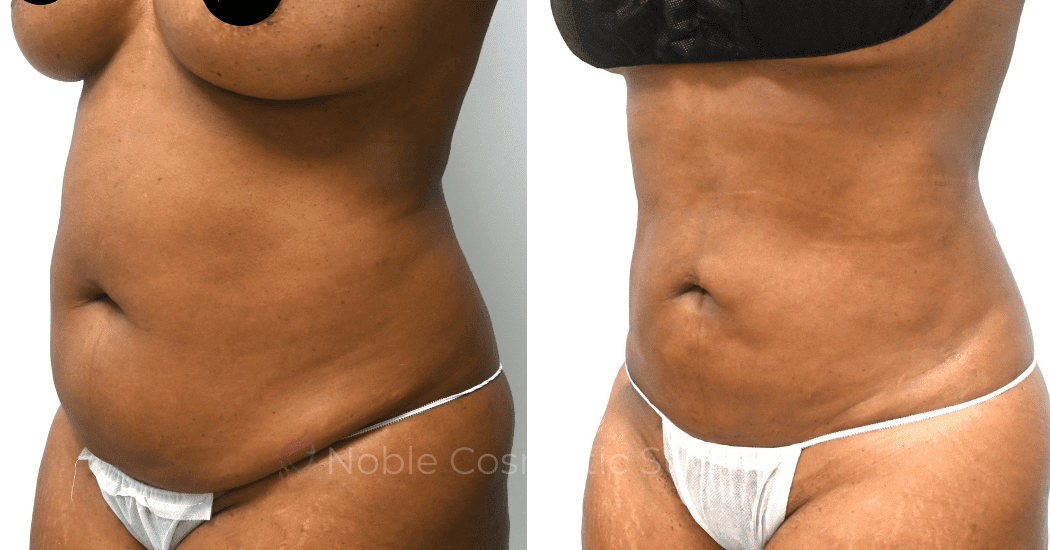 LIPOSUCTION-ABDOMEN-CASE-11016 | Before and After Liposuction 2