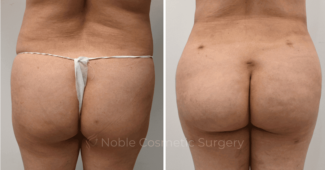Brazilian-Butt-Lift-Case-11116 | Before and After Brazilian Butt Lift