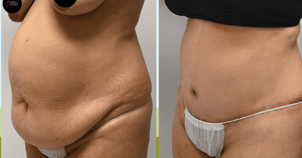 TUMMY-TUCK-CASE-11285 | Before and After Abdominoplasty 5