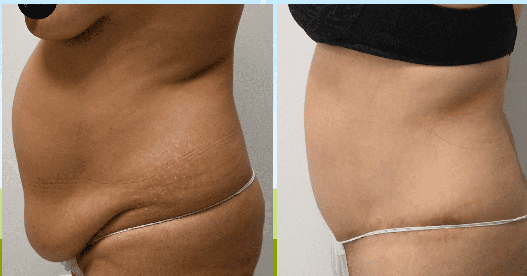 TUMMY-TUCK-CASE-11285 | Before and After Abdominoplasty 4