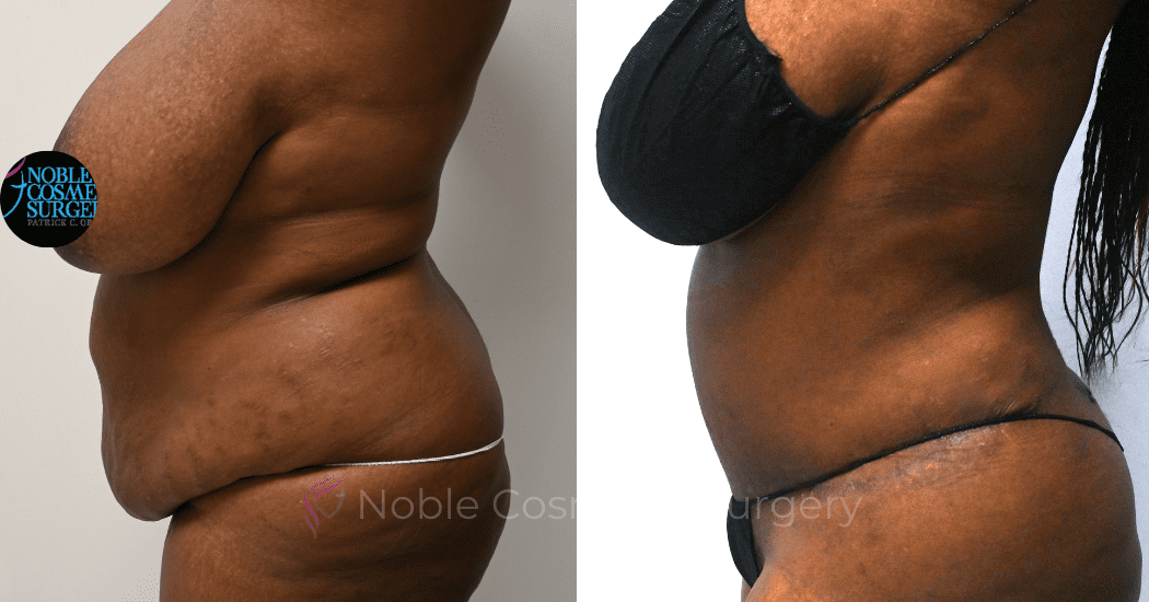 TUMMY-TUCK-CASE-11720 | Before and After Abdominoplasty 4