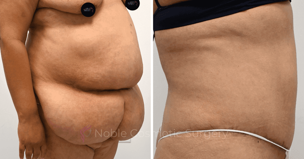 TUMMY-TUCK-CASE-12513 | Before and After Abdominoplasty 2