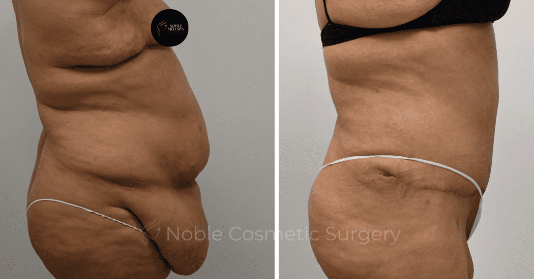 TUMMY-TUCK-CASE-12513 | Before and After Abdominoplasty 3