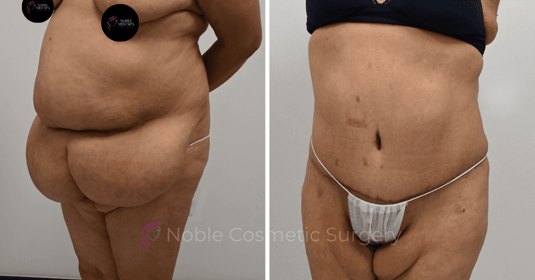 TUMMY-TUCK-CASE-12513 | Before and After Abdominoplasty 4