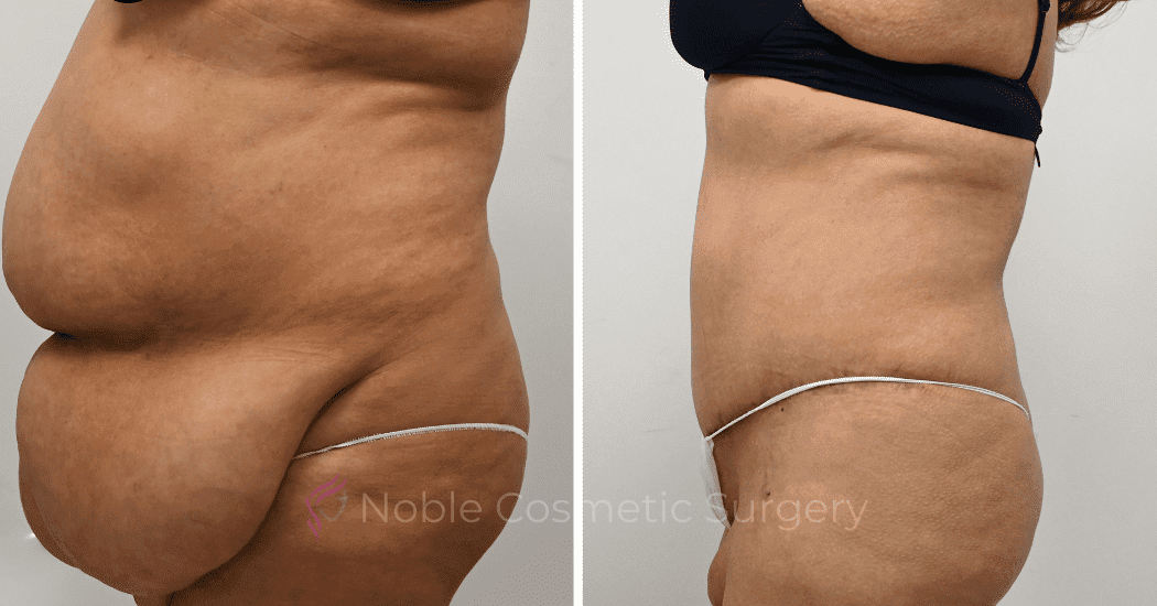 TUMMY-TUCK-CASE-12513 | Before and After Abdominoplasty 5