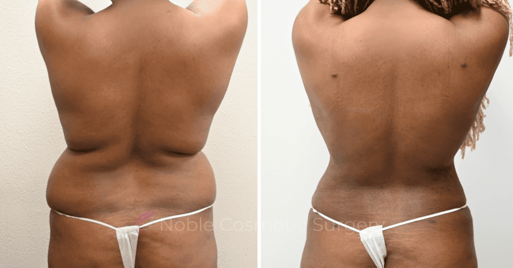 LIPOSUCTION-CASE-13859 | Before and After Liposuction