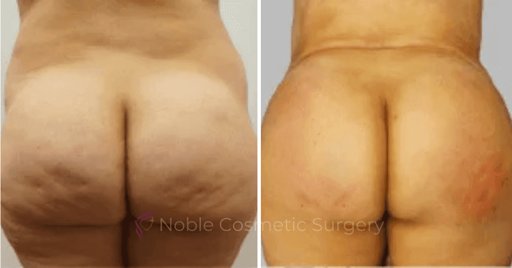 Brazilian-Butt-Lift-Case-15106 | Before and After Brazilian Butt Lift