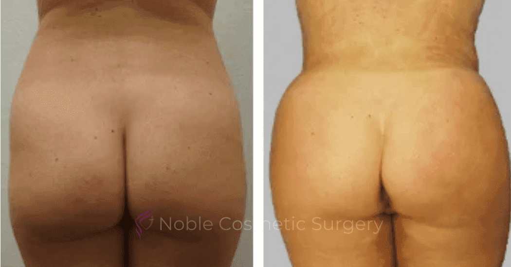 Brazilian-Butt-Lift-Case-15107 | Before and After Brazilian Butt Lift