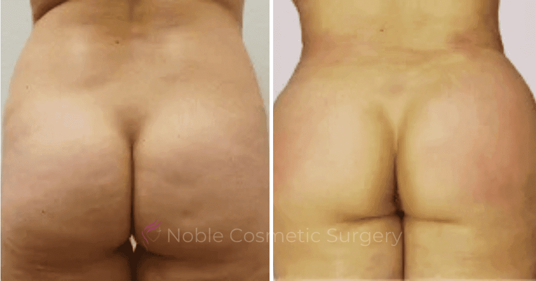 Brazilian-Butt-Lift-Case-15108 | Before and After Brazilian Butt Lift