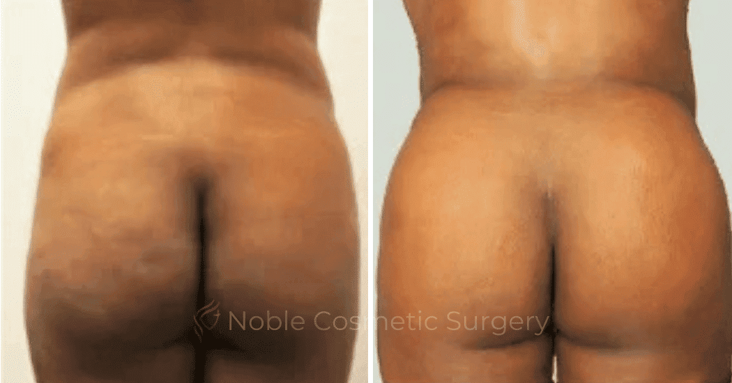 Brazilian-Butt-Lift-Case-15109 | Before and After Brazilian Butt Lift